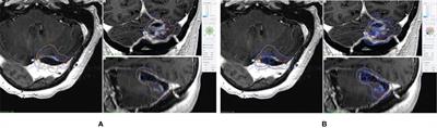 Clinical Evaluation of the Inverse Planning System Utilized in Gamma Knife Lightning